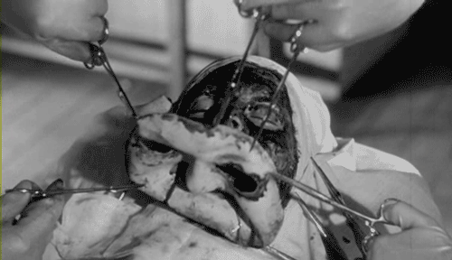 l'opération des "Yeux sans visage"